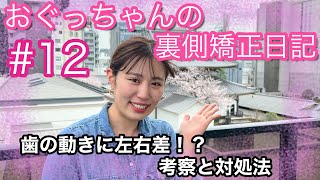 ♯12　現役歯科衛生士おぐっちゃんの裏側矯正日記