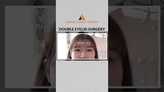 Double Eyelid Surgery | Answer Plastic Surgery #shorts #doubleeyelidsurgery