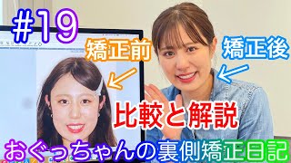 #19 現役歯科衛生士おぐっちゃんの裏側矯正日記