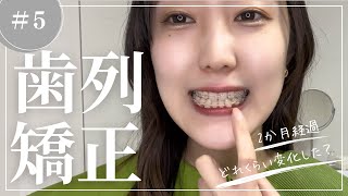 【#5 顎変形症】矯正2か月経過！歯はどれくらい動いた？ / ビフォアフあり