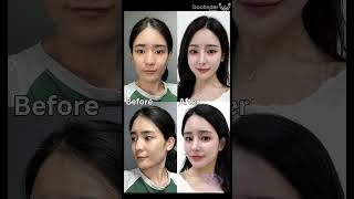 This transformation is PURE MAGIC! #plasticsurgerykorea #plasticsurgery #vline