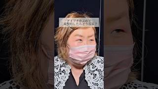 [Double eyelid surgery] #shorts What happens if you get an allergic reaction from using eyelid tape?