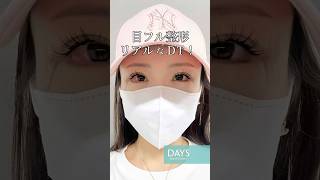 【二重整形】目フル整形術後1週間のリアルな経過！#shorts