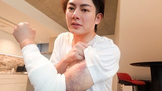 【緊急入院】バイク事故で体に残った後遺症について話します