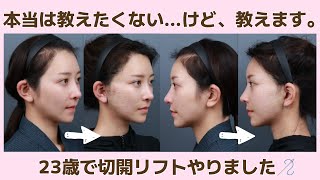 [Plastic Surgery Close-up] The clinic where I had my incision lift was so good it was amazing 💖