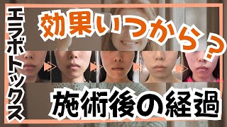 エラボトックス効果はいつから実感？1週間・1ヶ月後のリアルな経過