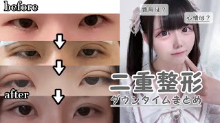 【二重整形】埋没をしてから約1年が経ちました。ダウンタイムの様子や心情、費用など全てをお伝えします。