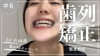 【#6 顎変形症】3カ月経過！写真で見比べてくよ～！