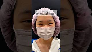 【二重整形】#shorts 修学旅行前に二重に…