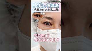 [Buried suture method for people in their 50s] Reduce the appearance of sagging and create sophis...